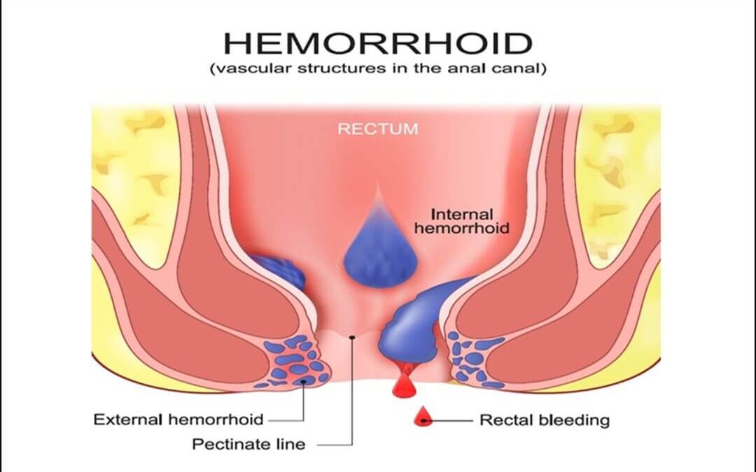 How to Reduce Hemorrhoid Swelling?