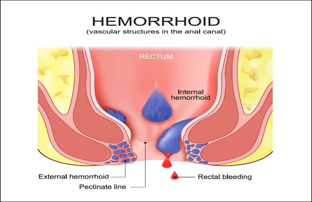 How to Reduce Hemorrhoid Swelling?