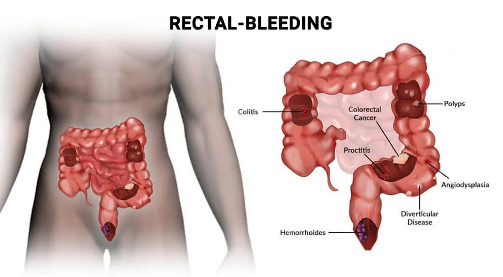 Rectal Bleeding: Causes, Symptoms and Treatment